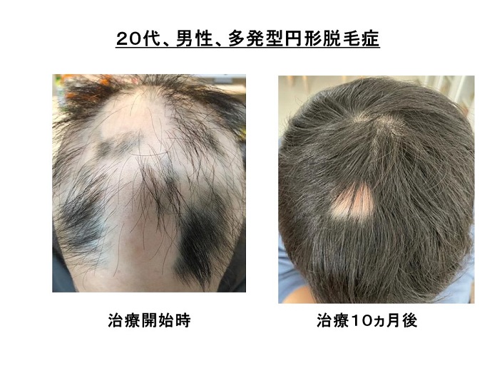 汎発性脱毛　病院